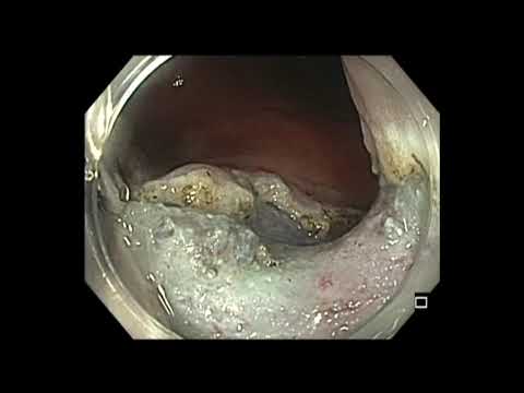 Coloscopie : mucosectomie endoscopique d'un gros polype du rectum - défaut de fermeture par clip