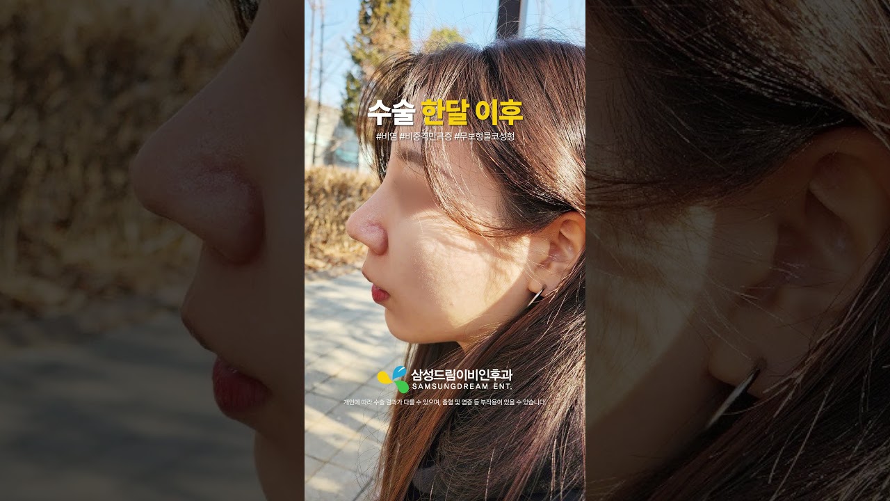 여자 무보형물코성형 한달 후기👍 #shorts #비염수술 #비중격만곡증수술 #코성형 #비밸브재건술 #여자코성형 #코성형브이로그 #코성형후기 #코성형전후 #무보형코성형