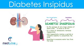 Diabetes Insipidus (DI): Causes, Symptoms, Diagnosis and treatment