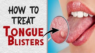 How to Treat Tongue Blisters Naturally | Home Remedies for Tongue Blisters Treatment
