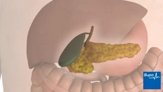 How keyhole gallbladder removal surgery is carried out