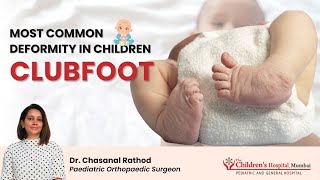 Clubfoot - Complete Information Diagnosis, Exercise Treatment at Home, Shoes, Su