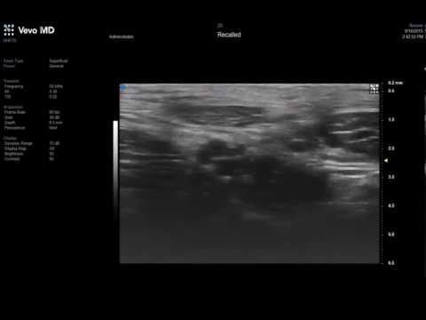 Vevo MD UHF 70 - Median Nerve  - Cross section of the nerve bundle
