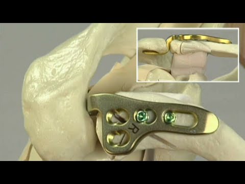 Lateral Clavicle - Dislocations and Fractures - The LCP Clavicle Hook Plate