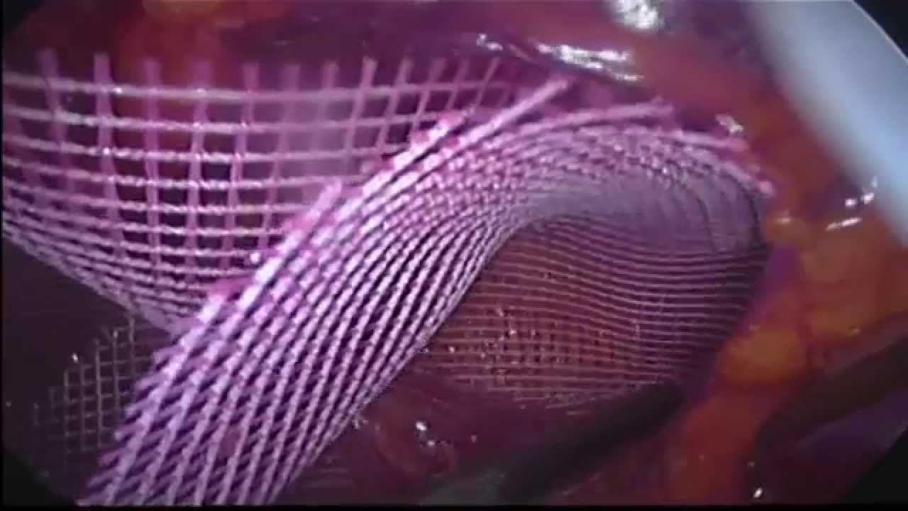 Laparoscopic Inguinal Hernia Repair (Extraperitoneal)