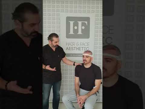 Hair Transplantation Interview 2 (English)