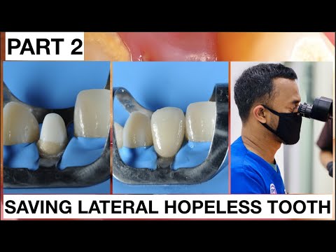 Step by Step Saving Lateral Hopeless Tooth. Part 2