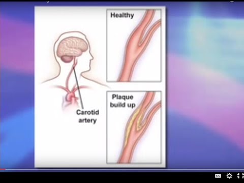 Risks and Benefits of Carotid Stenting