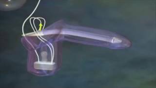 LA PROTHÈSE PÉNIENNE - IMPLANT PÉNIEN -