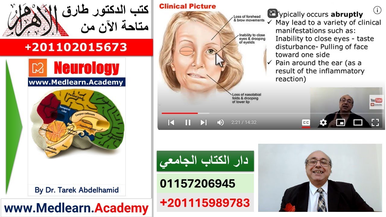 Bell's Palsy