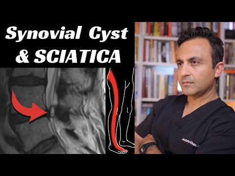 Synovial cyst & sciatica
