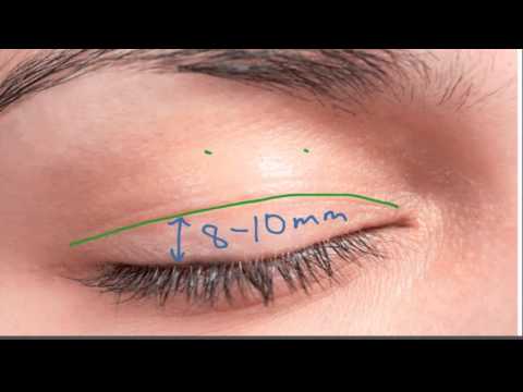 Marking the Upper Eyelid Incision