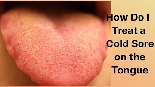 How Do I Treat a Cold Sore on the Tongue