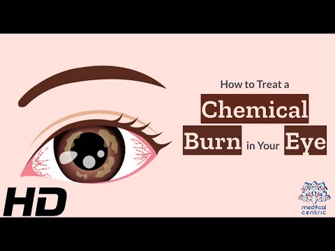 Eye Emergency: How to Properly Manage a Chemical Burn in Your Eye