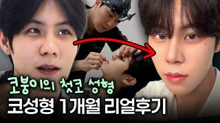 코 성형 1개월 남돌되어 돌아온 | 워나 첫코성형 리얼모델