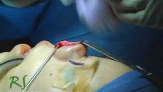 OR Video Footage: Exposing the Nasal Anatomy