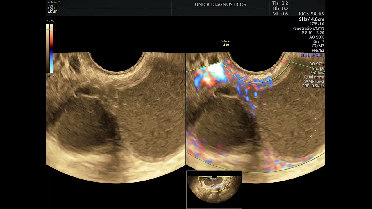 Vídeos de exames de endometriose Pt. 2