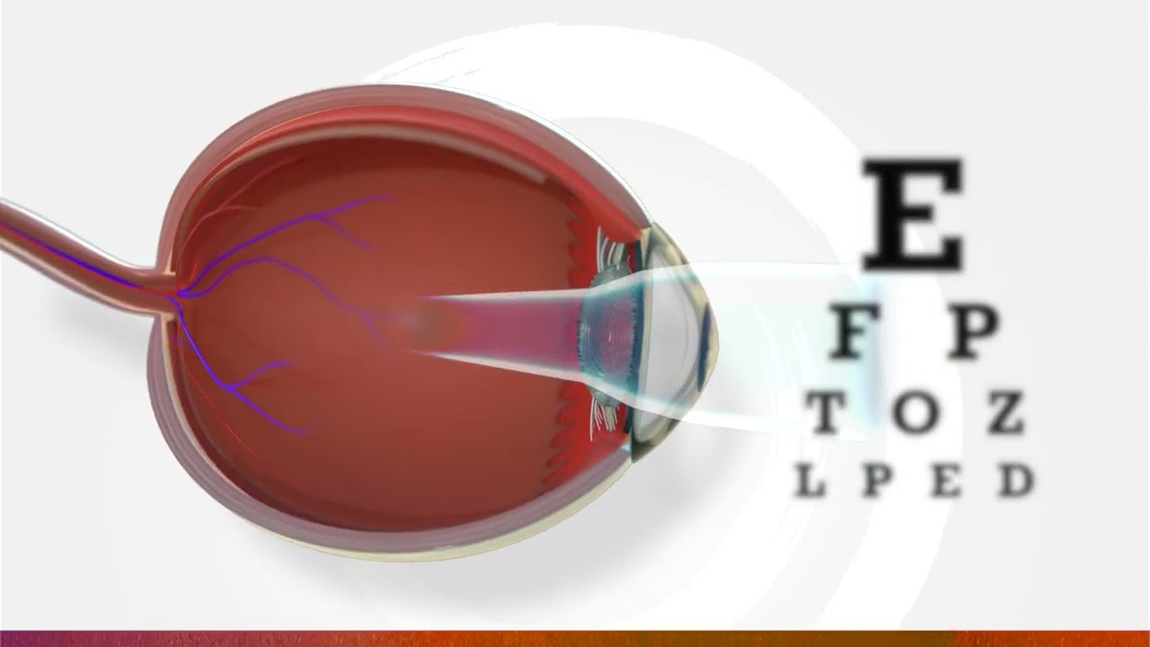 What is myopia? Watch the 3D animation video