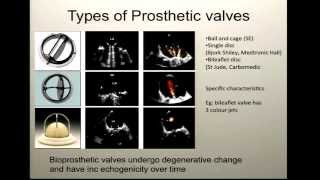 Dr Liza Thomas: The First Year of Follow-Up After Mitral Valve Surgery