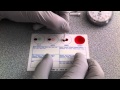 Blood Typing Using EldonCard (HD) 