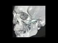 Zygomatic complex fracture - Gille's temporal technique for arch reduction