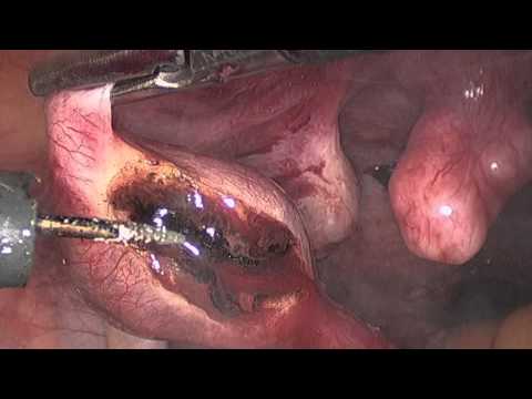 Leczenie laparoskopowe ciąży jajowodowej