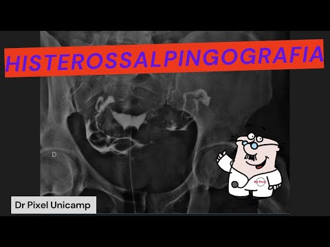 Fundamentos da histerossalpingografia