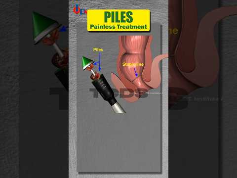 Worried About Piles Surgery? Choose a Bloodless, Painless Alternative