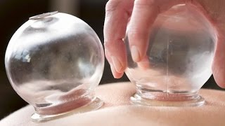 Mysterious Cupping Therapy;  Fire Cupping, Wet Cupping and Trypophobia