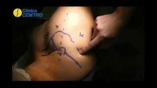 Artroscopia de hombro: mínima invasión, grandes beneficios