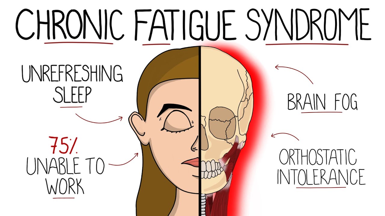 Myalgic Encephalomyelitis (Chronic Fatigue Syndrome) | Includes Criteria & Treatment