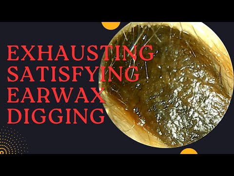 EXHAUSTING & SATISFYING Earwax Digging Until The End Of Ear Canal ‼️