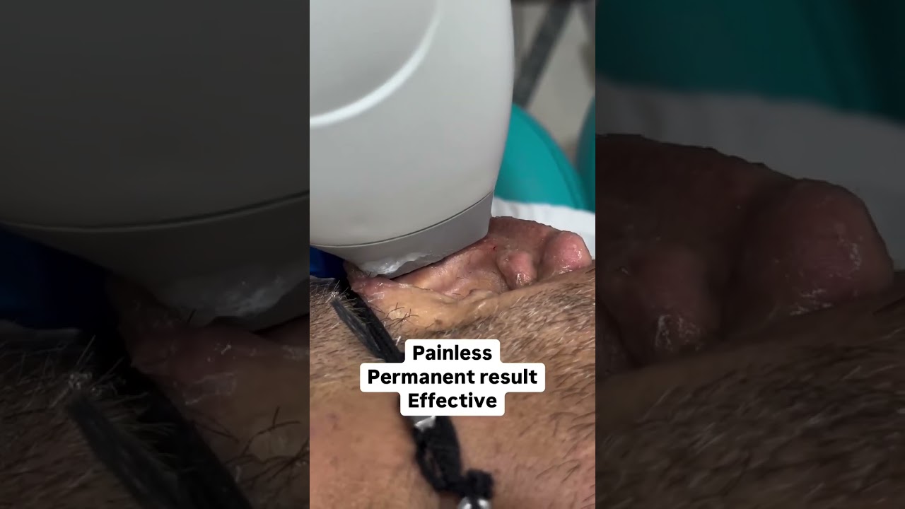 Ear 👂 - Laser Hair Removal