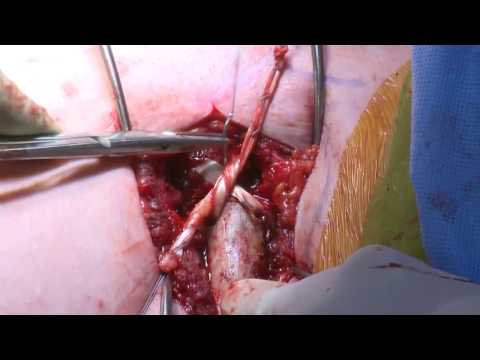 Reconstrucción de la articulación SC | Autoinjerto del tendón de Gracilis