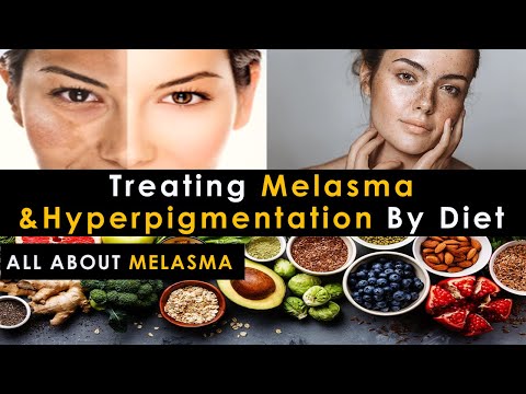 Melasma Cure Diet | Treat Melasma & HyperPigmentation By Diet | Treat Melasma Naturally