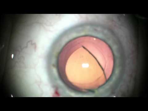 Retrait d'un implant intraoculaire multifocal