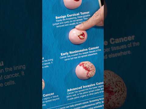 Stages of cervical cancer - From benign to advanced