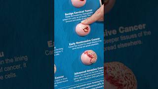 Download lagu Stages of cervical cancer - From benign to advanced mp3