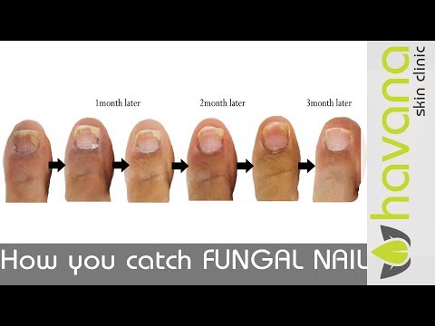 Mga tanawin at mga larawang kuko halamang-singaw Larawan ng kuko halamang-singaw paggamot remedyo katutubong