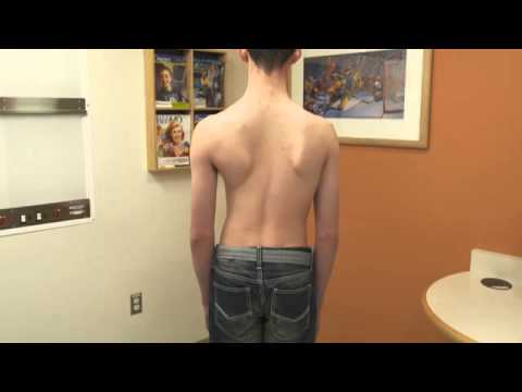 SRS Educational Video: Scoliosis Screening Exam