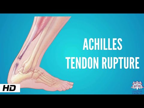 Achilles tendon rupture, Causes, Signs and Symptoms, Diagnosis and Treatment