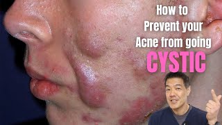 How to Prevent Acne from going CYSTIC