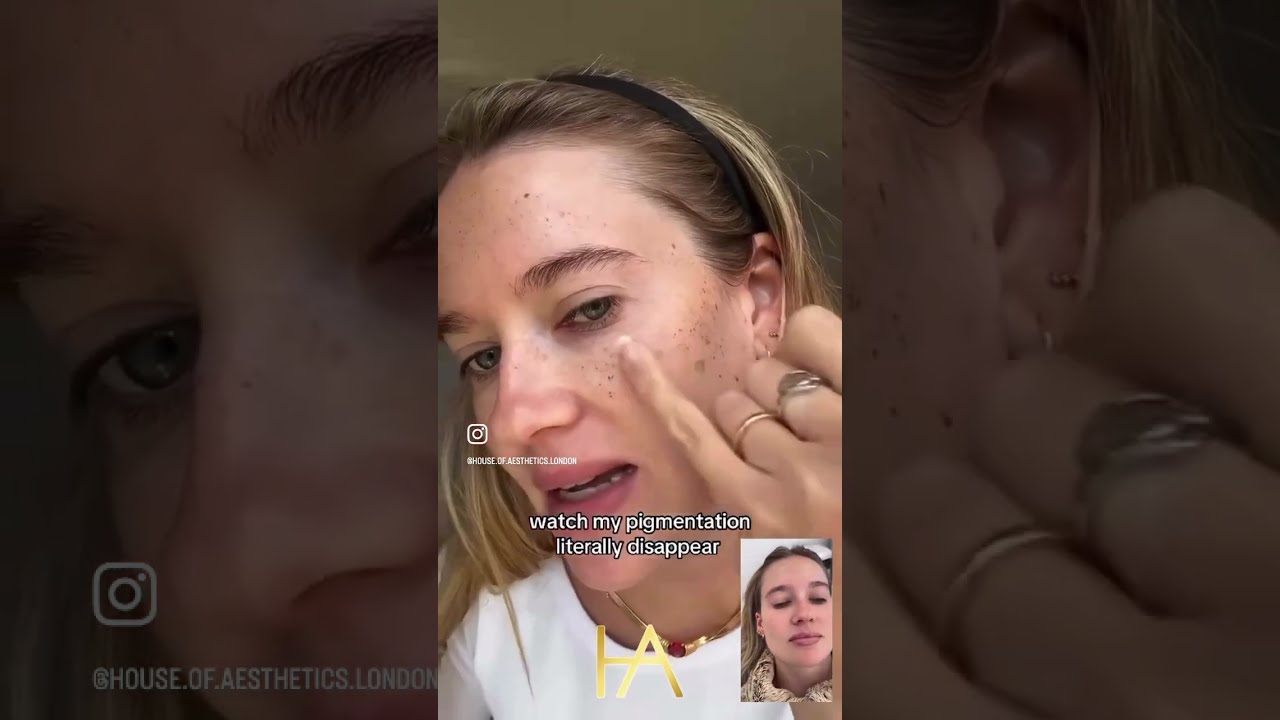 IPL Treatment Testimonial  video