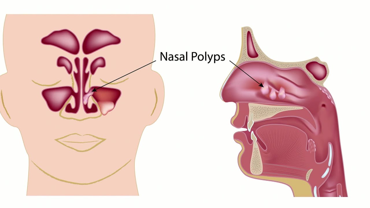 Causes of Nasal Polyps - YouTube