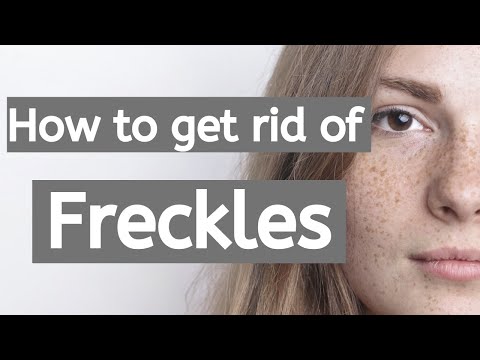How to get rid of Freckles | How to remove Freckles |...