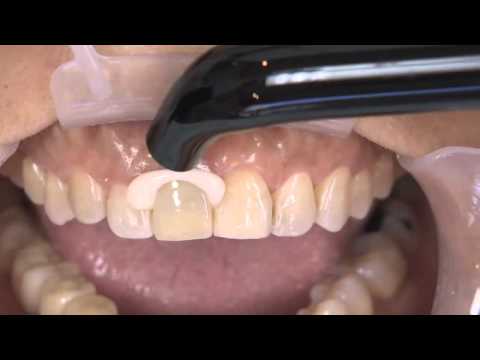 How to Complete an Anterior Dental Restoration with Kerr's Nexus RMGI