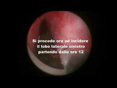 Prostatitis mit Krebs Kerzen von Prostatitis effektivem Preis