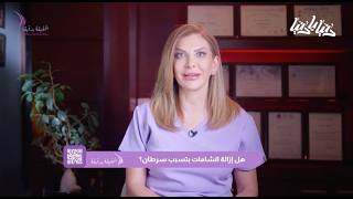 الحقيقة بدقيقة - الموسم الأول - الحلقة الثانية - إزالة الشامات هل تزيد خطر الإصابة بالسرطان؟
