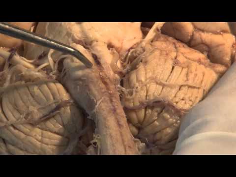 The Visual Pathway: Neuroanatomy Video Lab - Brain Dissections