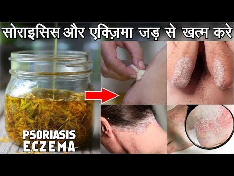 Psoriasis सोराइसिस, दाद, एक्जिमा, को ठीक  करने के असरदार नुस्खे | get rid of Psoriasis Video